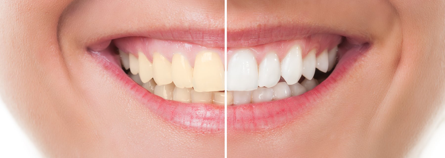 Before & After Orthodontic Transformations in Springboro, Ohio